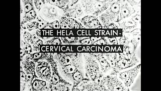 The HeLa Cell Strain Cervical Carcinoma Assn of American Medical Colleges 1956 [upl. by Remas569]