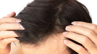 Can I Expect More Growth from my Hair Transplant After 11 Months [upl. by Sage]