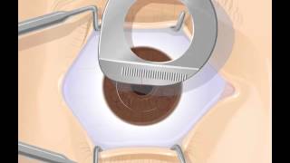 How LASIK Surgery is Done [upl. by Enohpets]