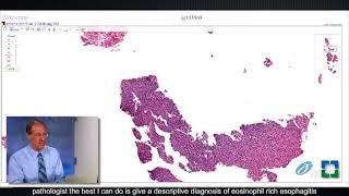 Pathology Insights Barretts Esophagus with John Goldblum MD [upl. by Cassius825]