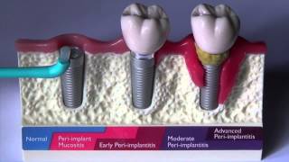 How to clean an implant that supports a denture [upl. by Pergrim531]