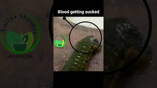 Leech therapy in skin disease in timelapse drpys [upl. by Auqenat]