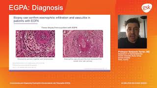 Diagnosis Understanding and diagnosing eosinophilic granulomatosis with polyangiitis EGPA [upl. by Aiotal143]