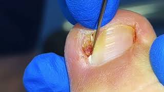 The PROFESSIONAL Way to Remove Ingrown Toenails [upl. by Ulund]