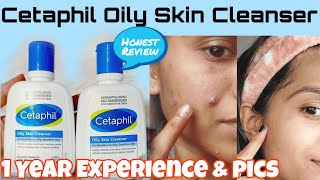 I Tried Cetaphil Oily Skin Cleanser For 1 Year😱Before amp After pics Best Cleanser for Oily Skin [upl. by Noxaj]