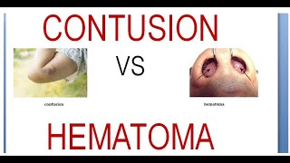 Surgery 011 Wound Contusion Hematoma Difference Vs Compare Between [upl. by Mohamed]