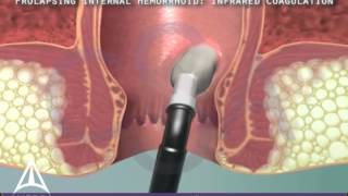 Infrared Coagulation Therapy for Hemorrhoids  3D Medical Animation [upl. by Williamsen]