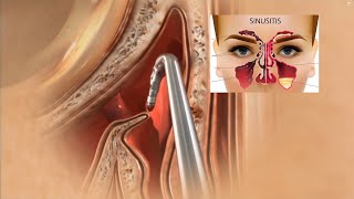 Sinus Surgery 3D Animation  Sinusitis Treatment  Sinus Operation [upl. by Refinne]