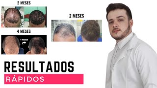 QUERO TRATAR MINHA QUEDA DE CABELO e CALVÍCIE MASCULINA DE FORMA RÁPIDA [upl. by Nahsor921]