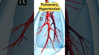 What Is Pulmonary Hypertension [upl. by Enylhsa]