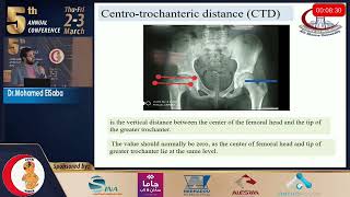 Session 43 Femoral neck lengthening for coxa brevia  Mohamed El Sabaa 232023 [upl. by Alemac]