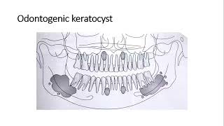 Odontogenic Cysts [upl. by Onihc]