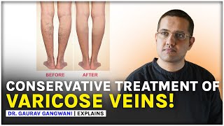 Varicose Veins Treatment Without Any Surgery  Dr Gaurav Gangwani Interventional Radiologist [upl. by Elletse]