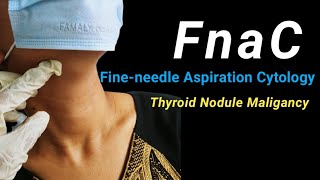 Fineneedle Aspiration Cytology of Thyroid Nodule Maligancy।। [upl. by Aihsenal]