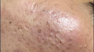 ACNE TREATMENT VU QUYNH MI Acne On Boys Cheek 2024 [upl. by Rellim67]