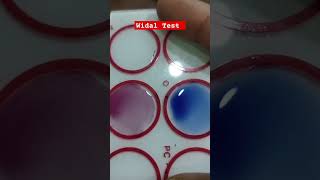 Widal Positive viralvideo shortvideo trendingshorts bloodtest labtechnician rajshilesh2025 [upl. by Atinauq]