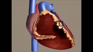Infarto Agudo do Miocárdio [upl. by Ssecnirp381]