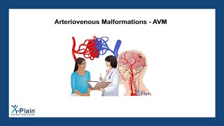 Arteriovenous Malformations  AVM [upl. by Neeruam820]