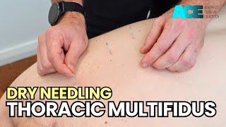 Dry Needling Thoracic Multifidus [upl. by Sabina]