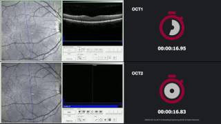 SPECTRALIS OCT1 vs OCT2 Retina – Dense Posterior Pole Scan [upl. by Nolubez]