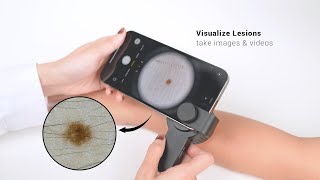 IBOOLO DE 3100 dermatoscope [upl. by Ylrebmic]