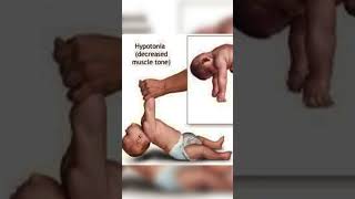 hypotonia baby parenting trending memes youtubeshorts shortsfeed [upl. by Aonehc]