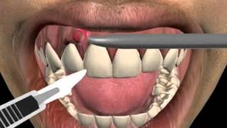 Bleeding Gums Easy Home Remedies to Stop Gums from Bleeding [upl. by Ynafit]