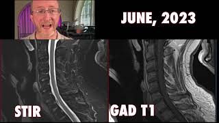 Scary Spinal MRI Multiple Sclerosis Spinal Cord [upl. by Niela]