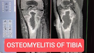 MRI of Tibia with Contrast  Diagnosing Osteomyelitis on GE 15 Tesla [upl. by Annaehs209]