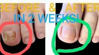 Kerasal  1 in Fungal Nail Removal Toenails amp Figure Nails IT WORKS HowTO Get Rid of Nail Fungus [upl. by Grubb]