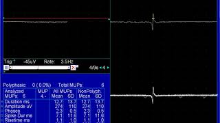 fibrillation potential [upl. by Killion]