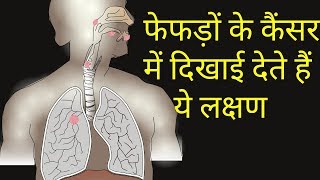 फेफड़ों के कैंसर के लक्षणfefdo ke cancer ke lakshanlungs cancer symptoms [upl. by Suoirred]