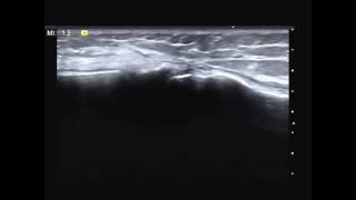 Infrapatellar branch of the saphenous nerve [upl. by Swiercz]