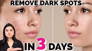 In 3 Days Remove DARK SPOTS BLACK SPOTS ACNE SCARS PIGMENTATION [upl. by Rivera]