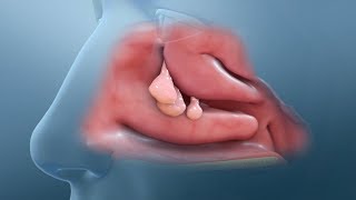 Nasal Polyp Removal Surgery [upl. by Donia]