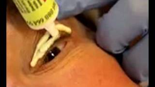 Permanent Eyeliner Pain Control by Dr Linda Dixon MD [upl. by Gurney]