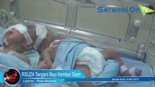 RSUZA Aceh Tangani Bayi Kembar Siam Dempet Kepala [upl. by Obeded]