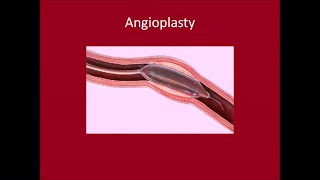 Angioplasty [upl. by Celia]