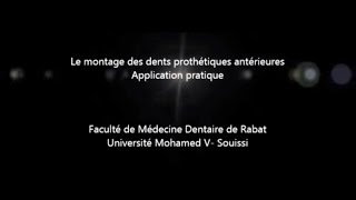 Montage des dents prothétiques antérieures [upl. by Leugar]