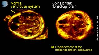 Spina bifida 3D ultrasound diagnosis at 1113 weeks [upl. by Malvin]