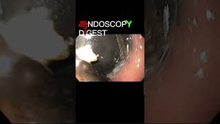 Endoscopy appearance of intragastric migrated lapband shorts [upl. by Aihsemek]