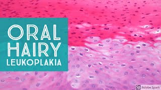 Oral Hairy LeukoplakiaExplained by a Dermatopathologist [upl. by Robma654]