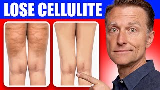 Get Rid of Cellulite for Good Dr Bergs Better Way to Lose Flabby Fat [upl. by Buckler]