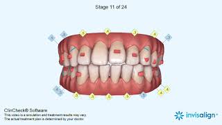 Invisalign ClinCheck® [upl. by Cuthbertson726]