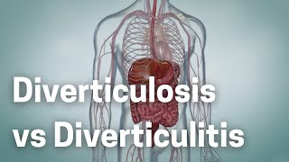 Diverticulosis vs Diverticulitis The Silent Threat Inside Your Gut [upl. by Billat748]