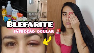 PEGUEI UMA INFECÇÃO NO OLHO E QUASE PERDI A VISÃO  BLEFARITE  ALERTA 🚨 [upl. by Picco527]