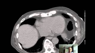 CT Abdomen and Pelvis ANATOMY Discussion by Radiologist [upl. by Plusch853]