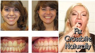 How To Fix Crossbite Teeth Naturally Without Surgery Without Braces  CrossBite Teeth Correction [upl. by Nivre808]