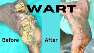 THE BIGGEST FOOT WART EVER PLANTAR WART REMOVAL SURGERY Largest wart removal in Ranchi [upl. by Doownel701]