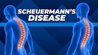 Top Three Exercises for Scheuermanns Disease [upl. by Lasorella]